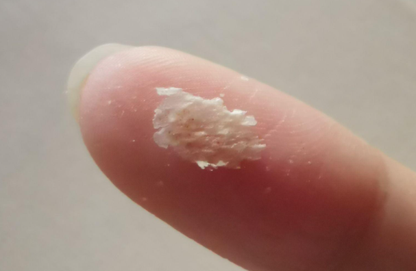 头皮上那些“斑块”能抠掉吗? - 品悦舍