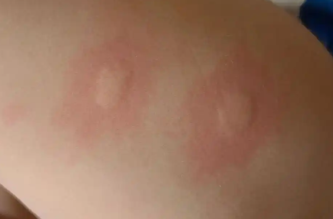 被蚊子咬后痒痛的背后,竟藏着这些秘密 - 品悦舍